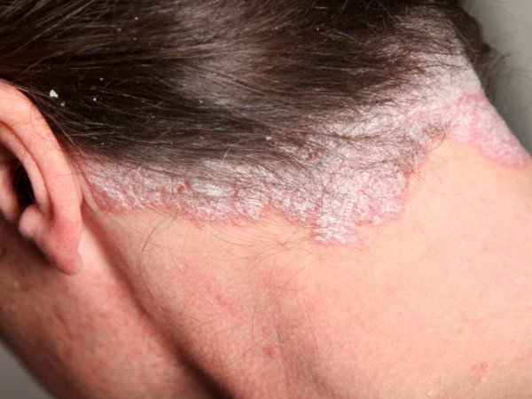 AMCPSO's tweet photo. ¡Informémonos y #HablemosDePsoriasis! La psoriasis puede aparecer a cualquier edad y afecta a ambos sexos por igual.
#SomosAMCPSO https://t.co/2UnFuBi8Us