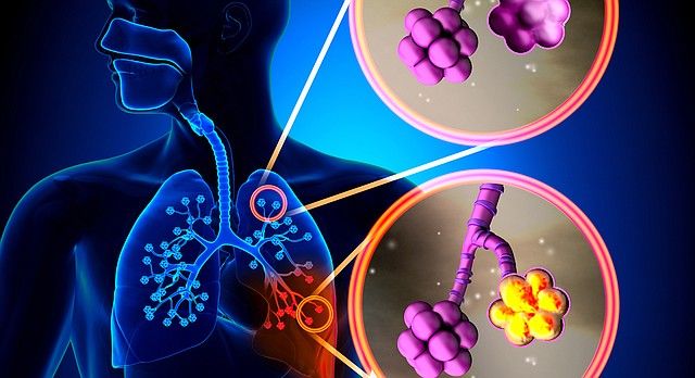 Pneumonia vaccine an important defense bit.ly/2hOd51m