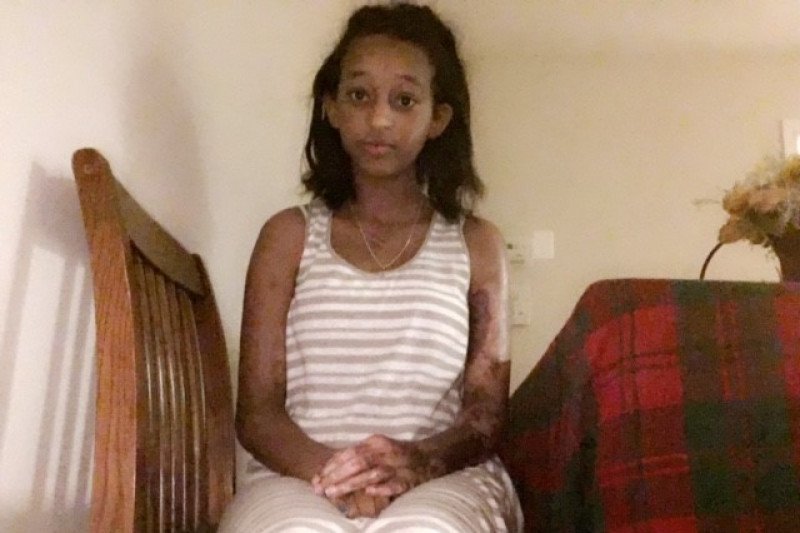 Pls help fire victim Bitseat. She needs help w support 2 go back 2 school. She was burnt all over :( bit.ly/2iEDJcv