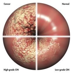 EmmaKay1985's tweet photo. #CervicalCancerAwarenessMonth The 2 minute test can save your life. It probably did for me. High CIN cells. @CervicalScreen1 #gosmearnofear https://t.co/vZbvNzfbH9