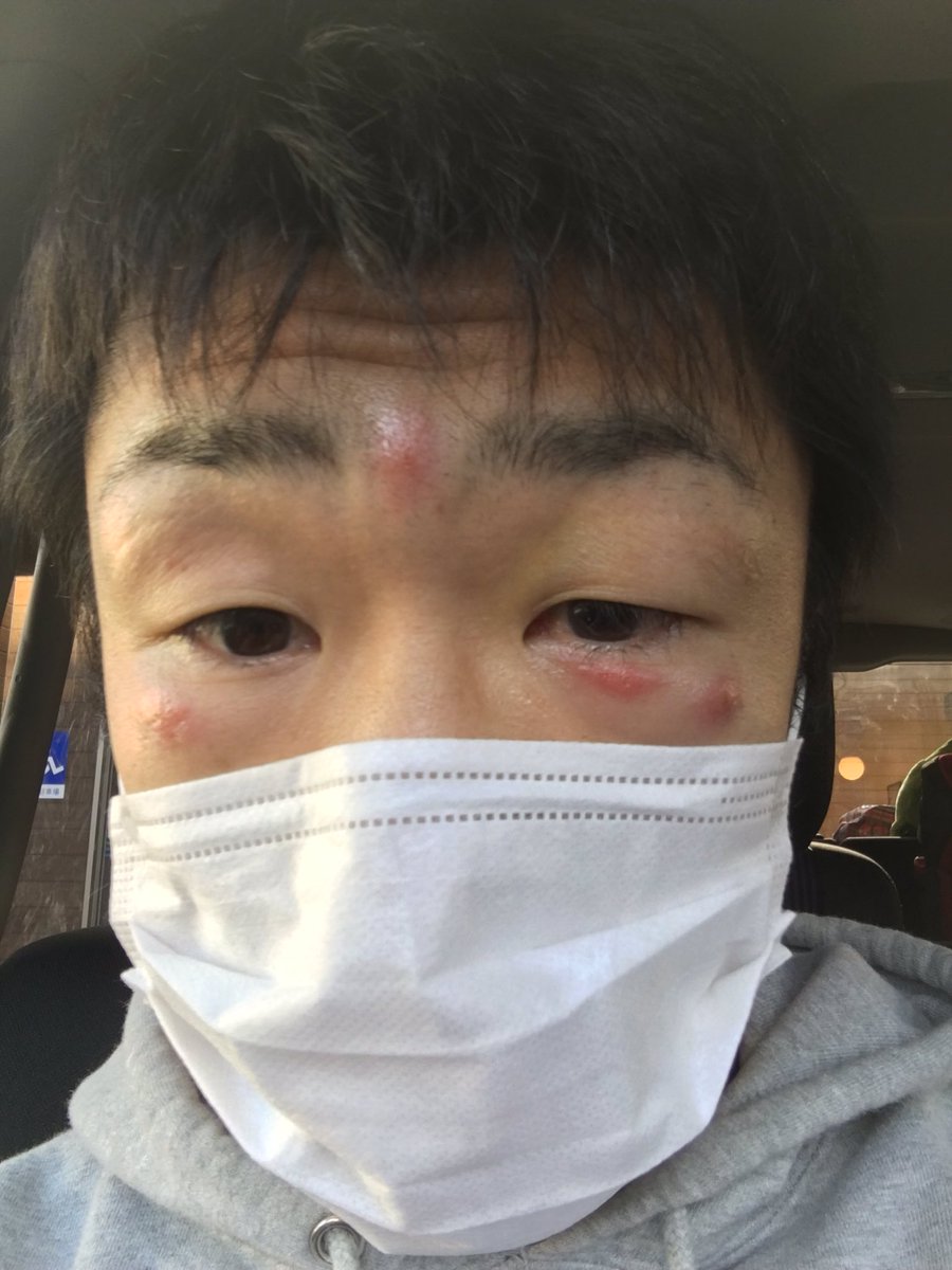 八重樫東 A Twitter 試合で顔が珍しく腫れなかったのに 試合後数日経ち 謎の吹き出物が顔に W 試合を見たファンの方に 試合の傷が残ってるね って言われます W この吹き出物なに 八重樫東 A Twitter 試合で顔が珍しく腫れなかったのに 試合後数日経ち 謎の吹き出物が顔に W 試合を見たファンの方に 試合の傷が残ってるね って言われます W この吹き出物なに