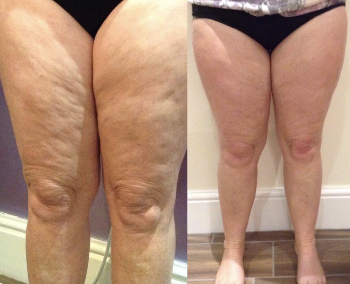 Fantastic result with <a href="/3Dlipo/">3D-lipo</a>, 8 sessions with cavitation and 3D dermaology to achieve inch loss &amp; reduce cellulite