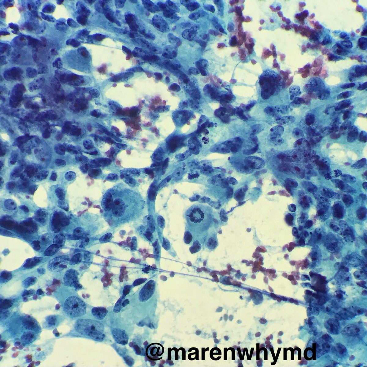 marenwhymd's tweet photo. Sometimes the tumor brings you a ring 💍 👀🔬 #FNApath #cytopath #cytology #pathology #prostatecancer #badness #ringmitosis https://t.co/yt5xp6Pa3H