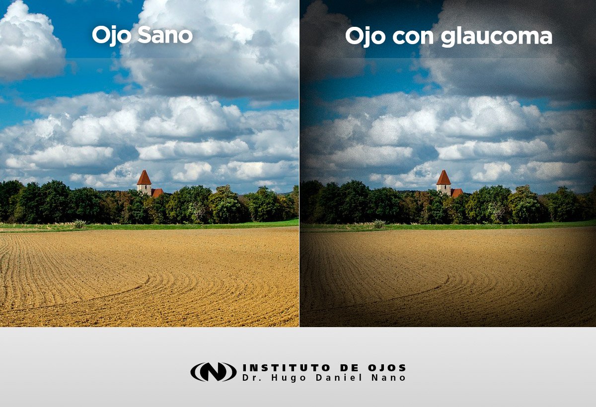 instituto_nano's tweet photo. #Sintomas #Glaucoma. En un estadío avanzado, el síntoma es una visión tubular, conocida también como “visión en caño de escopeta” https://t.co/2hlAg5tFiS