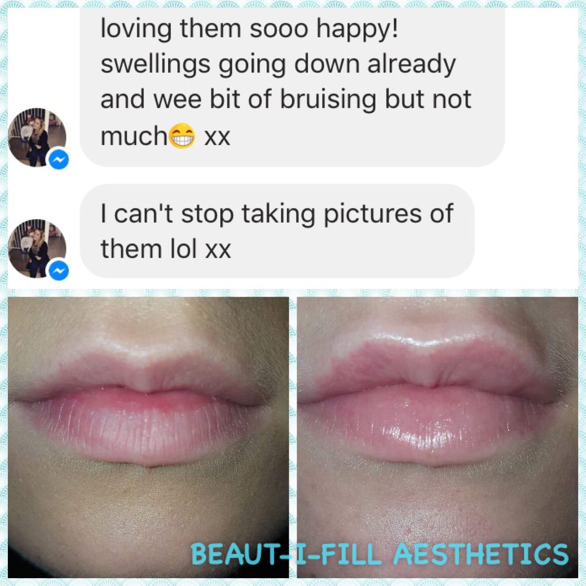 Beautifillers's tweet photo. Making people happy is what it's all about 💋💋#luciouslip #perfectpout #subtleenhancement #meetingpeoplesexpectations https://t.co/GJ77SiZ32R