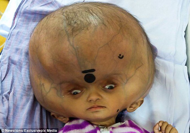 Daily Mail Online Boy With The World S Largest Head Has Surgery To Remove 3 7 Litres Of Fluid From Around His Skull T Co Xi2ykmujmc T Co P46uscymw0 Daily Mail Online Boy With The World S Largest Head Has Surgery To Remove 3 7 Litres Of Fluid From Around His Skull T Co Xi2ykmujmc T Co P46uscymw0