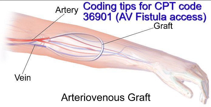 jitendra000557's tweet image. Amazing tips for New #CPTcode 36901 for #AVfistula Access in #surgerycoding for #medicalcoders in #newyear2017 sumo.ly/u2nt