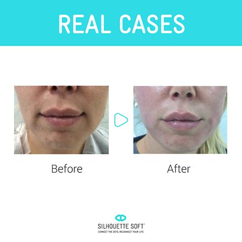 HBHealthClinic's tweet photo. Check out these great results from a treatment #silhouettesoft #SkinRenewal #facialthreads #antiageing https://t.co/LwIDB7Gnzl https://t.co/m7wHzRYZw0