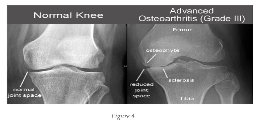 osteoarthritis radiology findings)