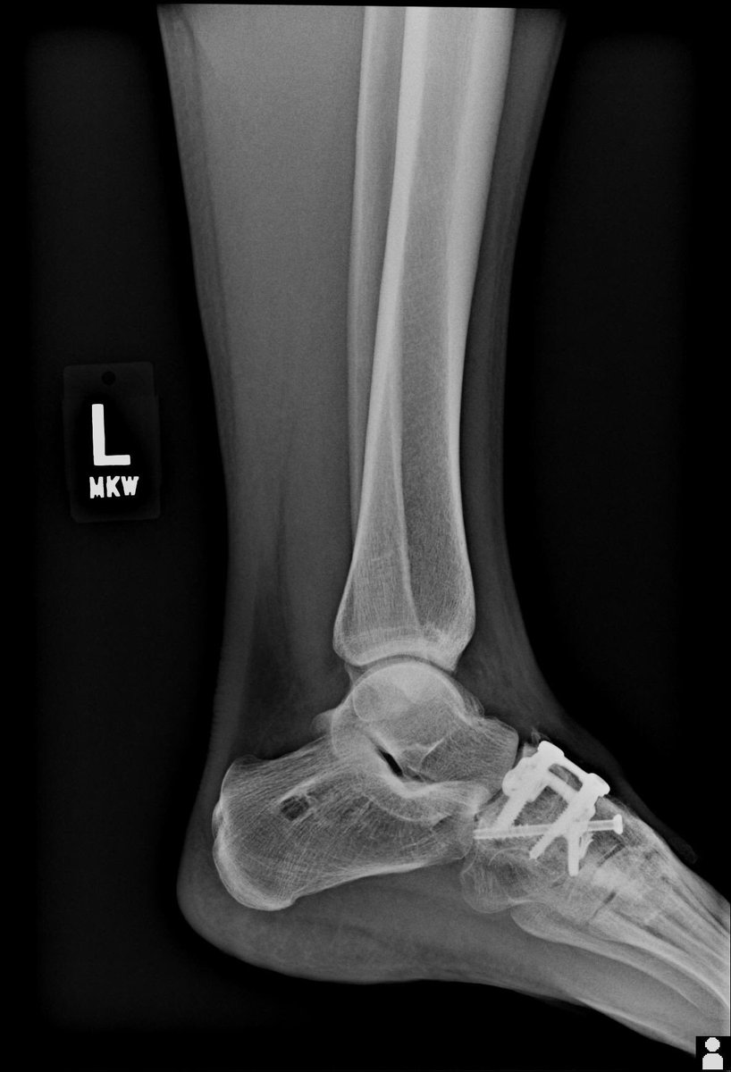 Thx for sharing your LBP story <a href="/themovementfix/">Movement Fix</a> - My own ortho injuries have helped make me a better clinician. #empathy #lisfranc #health