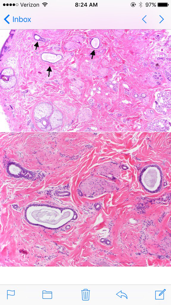 LenSperling's tweet image. Eccrine duct distention commonly seen in cicatricial alopecia. Not specific, found in CCCA, DLE,LPP