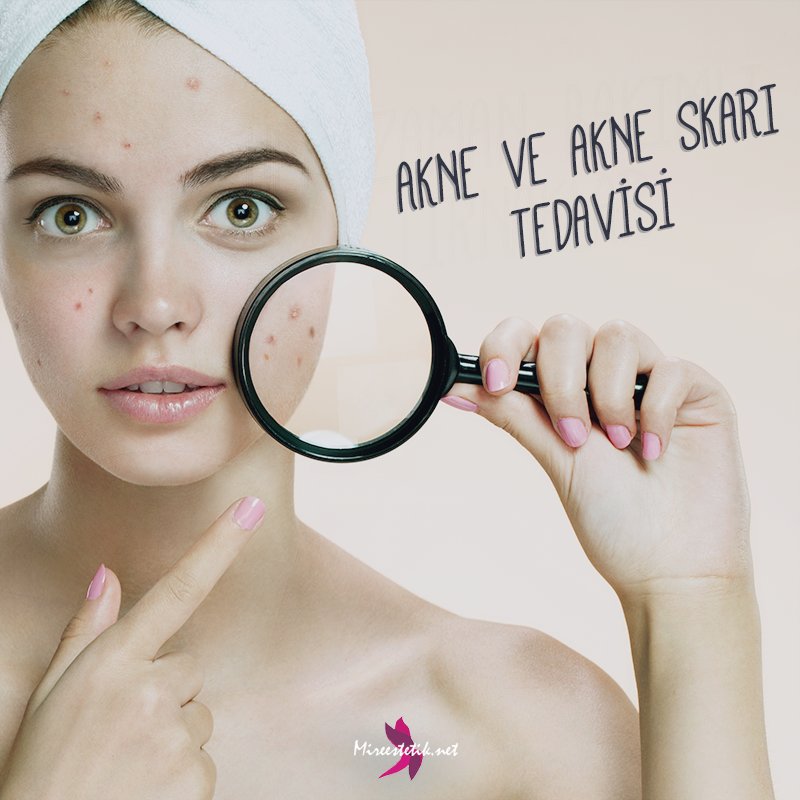 Dermatherapy ve kimyasal peeling yoluyla akne ve akne skarı tedavisi için Mire Estetik'e bekleriz.
#mireestetik #izmir