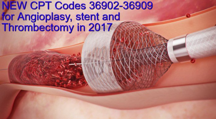 jitendra000557's tweet image. New #CPTcode in 2017, 36902, 36903, 36904, 36905 and 36906 in #surgerycoding for #medicalcoders #icd10 #aapc #ahima sumo.ly/u7ej