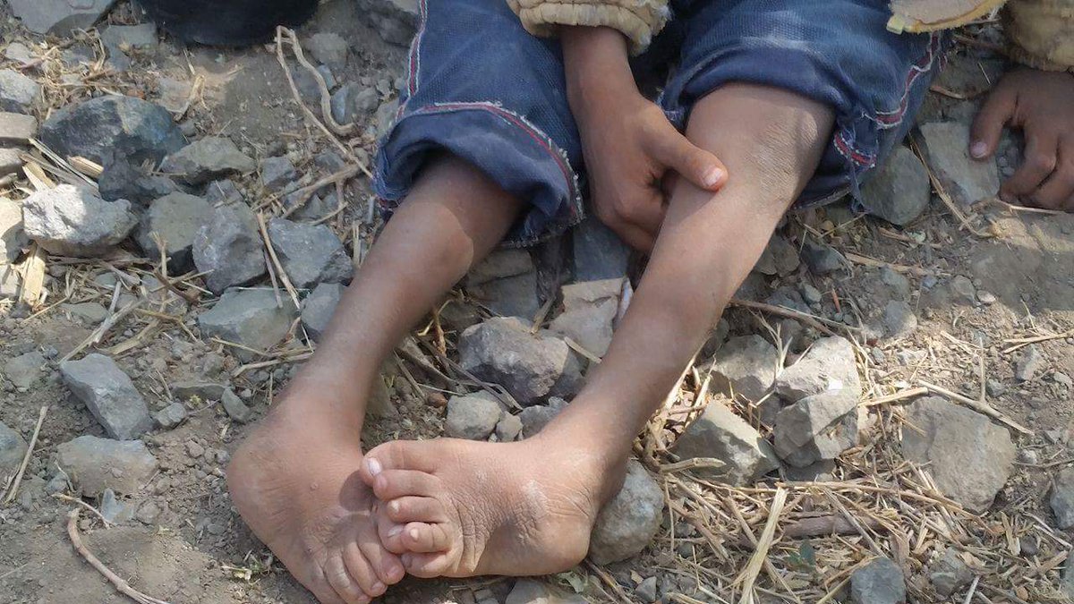 SEYAJ's tweet photo. more than 1100 child are facing death and disabilities due to the severe shortage of food in Alqafer district in Ibb province.
#Yemen #SEYAJ https://t.co/TbGJCCP8Pm