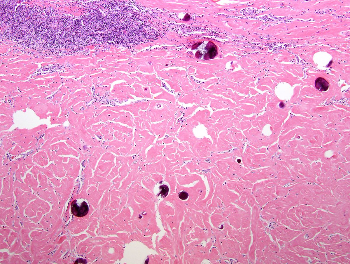 ARP_Press's tweet photo. Calcifying fibrous pseudo/tumor, a benign lesion first noted as soft tissue pediatric tumors but also encountered in the viscera of adults. https://t.co/jgtXeeMTgw