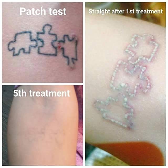 spectrumremoval's tweet photo. #tattooremoval #tattooregret #spectrumtattooremoval #tattoofixers #tattoo https://t.co/6hh9Q5XNwo