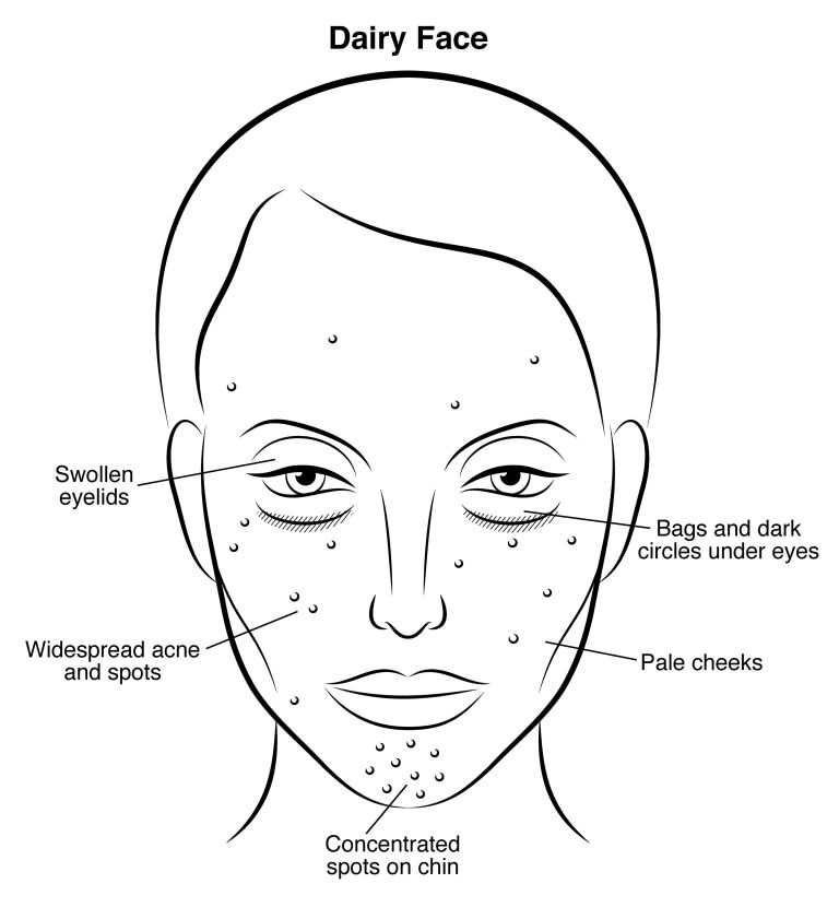 drnigma's tweet photo. If you have #DairyFace, take #EveningPrimroseOil for its #antiinflammatory effects. #AskDrNigma https://t.co/tz5HXKiAC1
