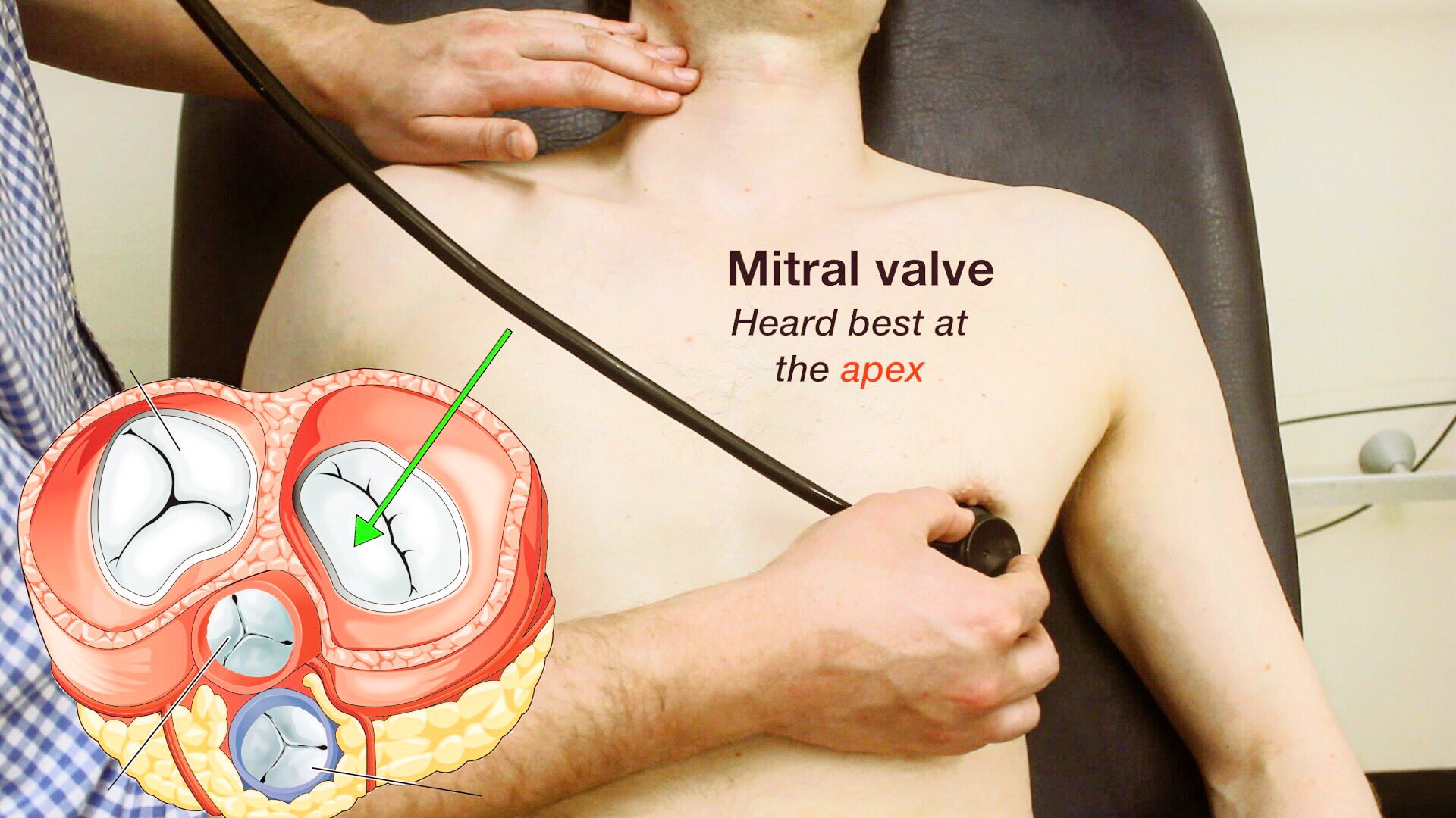 Mitral Valve Location Intercostal Space