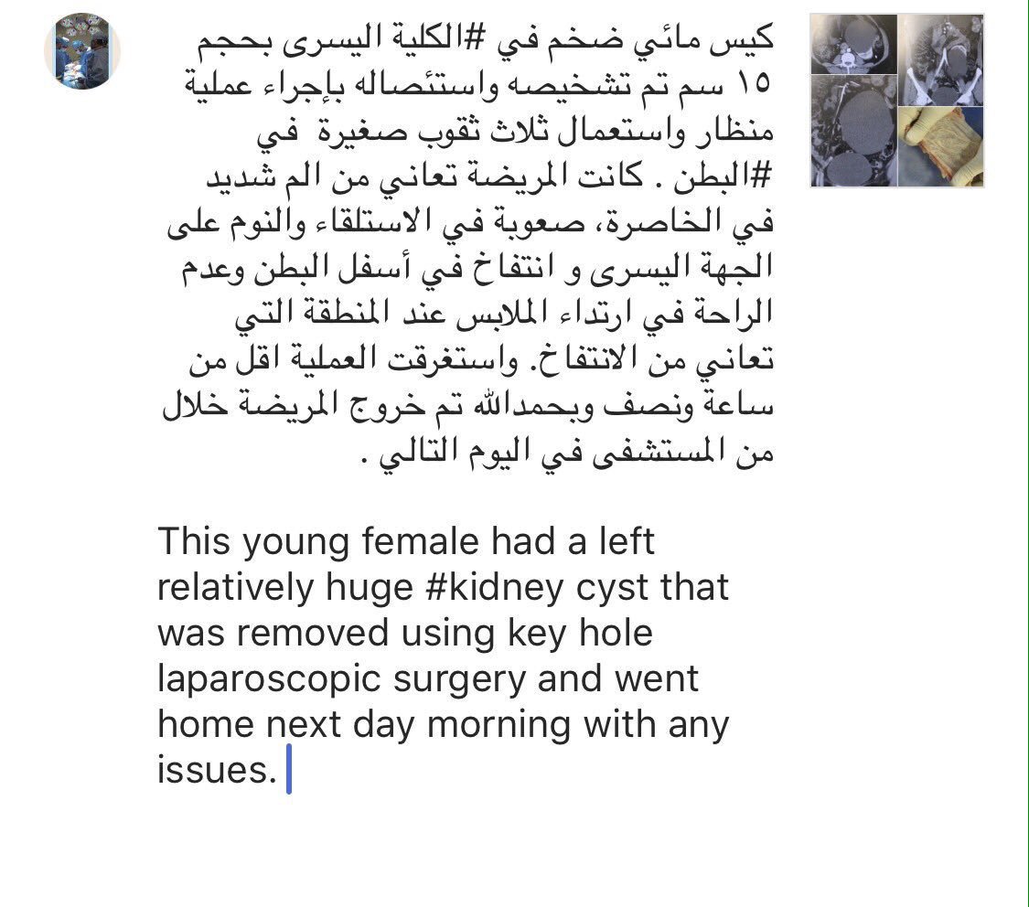 Company_Twiter's tweet photo. د-احمد العنزي 
تم استئصال كيس مائي ضخم من الكلية اليسرى بعملية منظار للبطن بثلاث ثقوب صغيرة وقد غادرت المريضة في اليوم التالي
#urologist4u https://t.co/VJL8CV4gR5