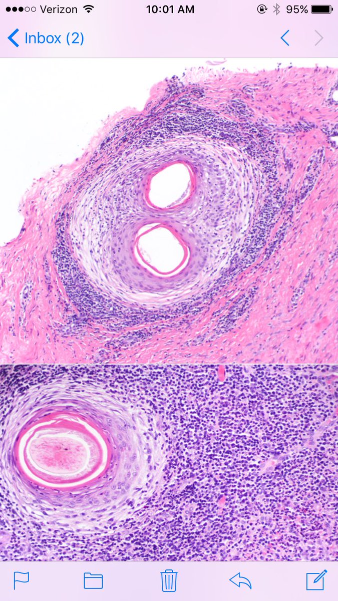 LenSperling's tweet image. Follic. decalvans: not specific disease--PATTERN of very inflam cicat alop, usually from CCCA or LPP. Polytrichia (fused infundibula common)