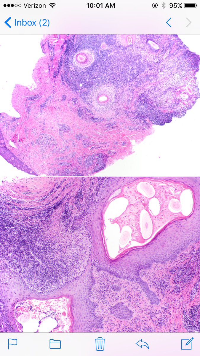 LenSperling's tweet image. Follic. decalvans: not specific disease--PATTERN of very inflam cicat alop, usually from CCCA or LPP. Polytrichia (fused infundibula common)