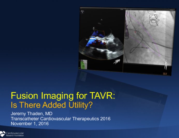 TCTMD's tweet photo. Fusion Imaging for #TAVR: Is There Added Utility? A #TCT2016 Featured Presentation https://t.co/IO5aTNMRbW https://t.co/PbBNWVRwYT