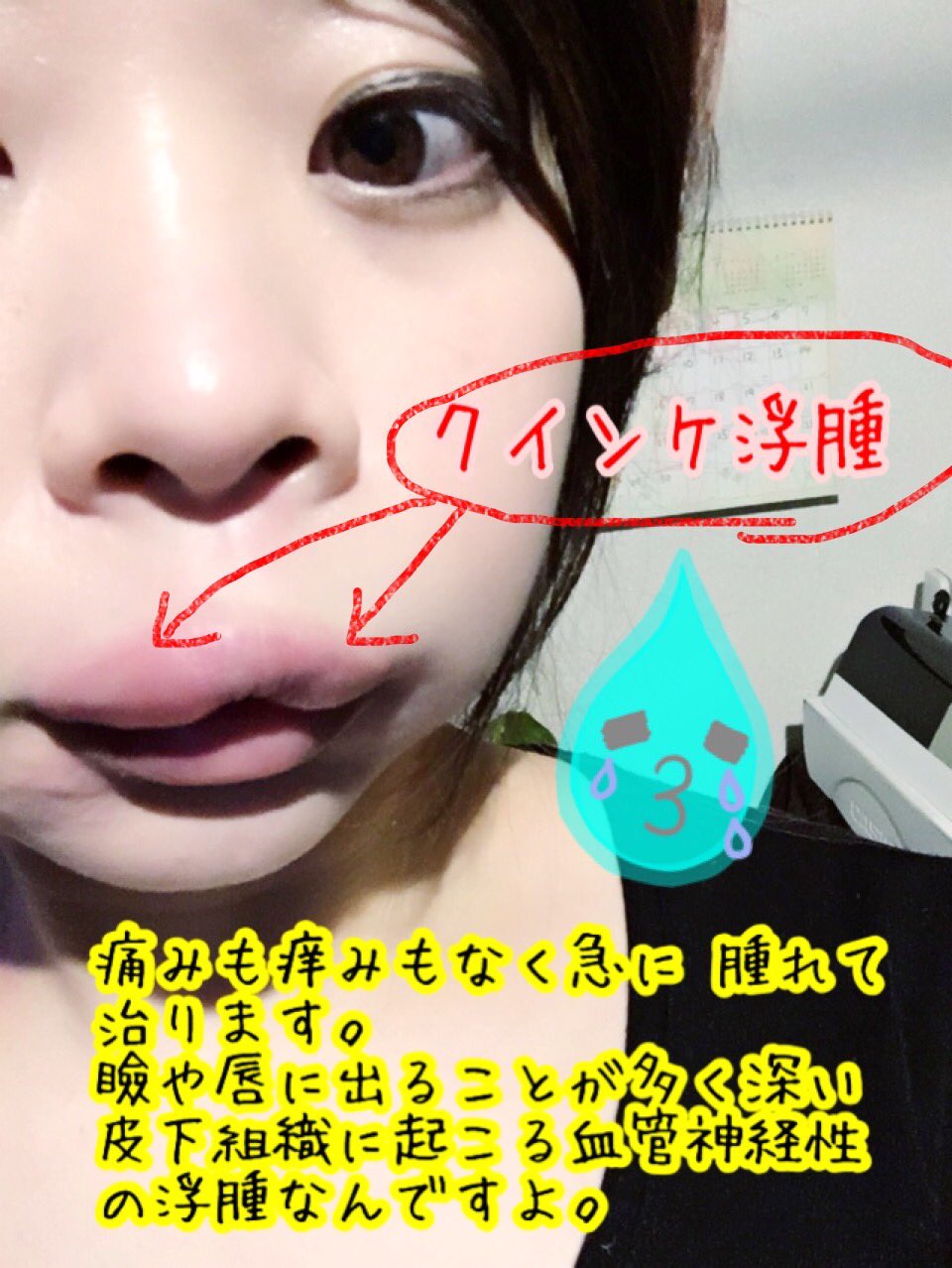 柔整鍼灸師 貴代香 ふくろう鍼灸院 千葉 V Tvittere 急に唇が腫れました 泣 先週は瞼や目の下が腫れました でも急に腫れて次の日にはすっかり消えてるのでクインケ浮腫だと思い 患者様で何人か見た事あったのですが自分でなるのは初めて 原因は様々ですがストレスや 柔整鍼灸師 貴代香 ふくろう鍼灸院 千葉 V Tvittere 急に唇が腫れました 泣 先週は瞼や目の下が腫れました でも急に腫れて次の日にはすっかり消えてるのでクインケ浮腫だと思い 患者様で何人か見た事あったのですが自分でなるのは初めて 原因は様々ですがストレスや