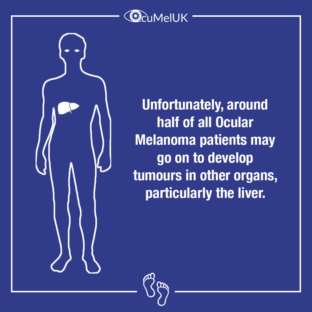 KP24Foundation's tweet photo. There are approximately 600 new cases of uveal melanoma in the UK each year, making it a rare cancer. @OcuMelUK https://t.co/aW4uukjI1M
