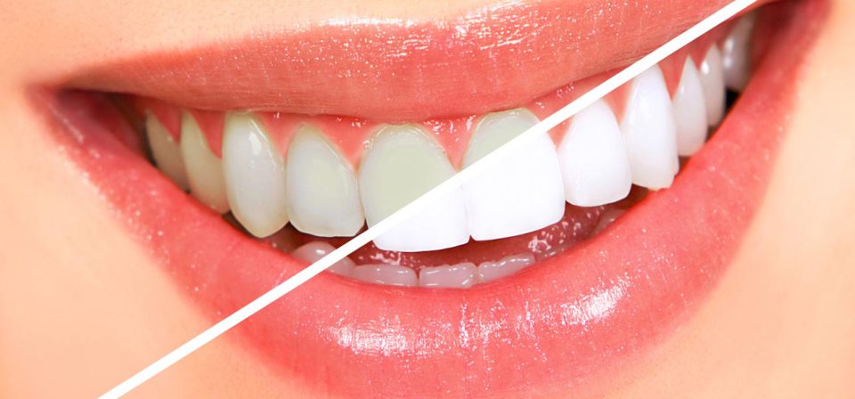 KweenAngela's tweet photo. Get white teeth fast at home with this white teeth tips - https://t.co/ZwnBFyy0dJ https://t.co/02KqpGxGBd