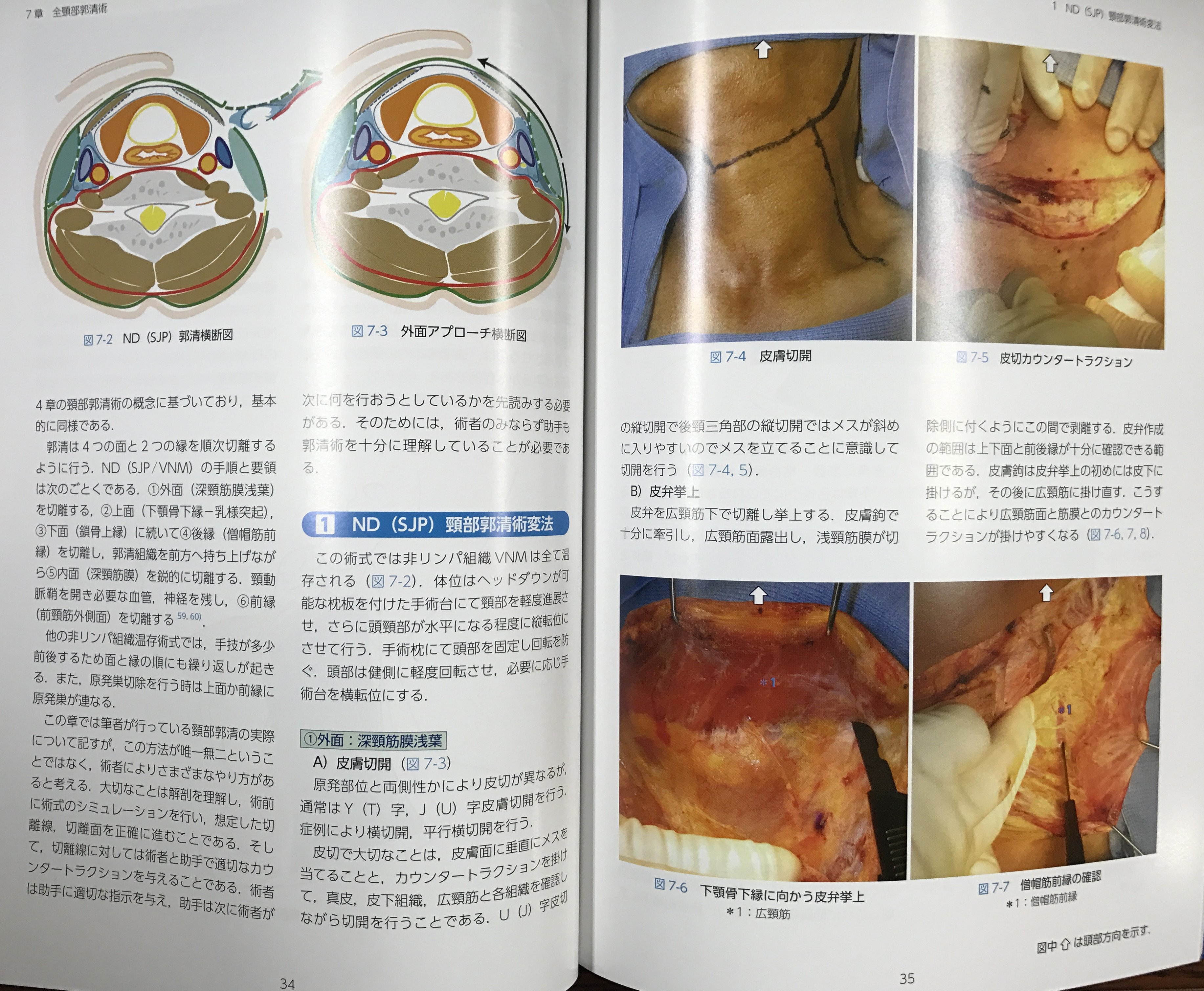 頭頸部がん手術ノート 輪層の外科 長谷川 泰久 81gmNvj8j9L._UF350,350_QL50_.jpg
