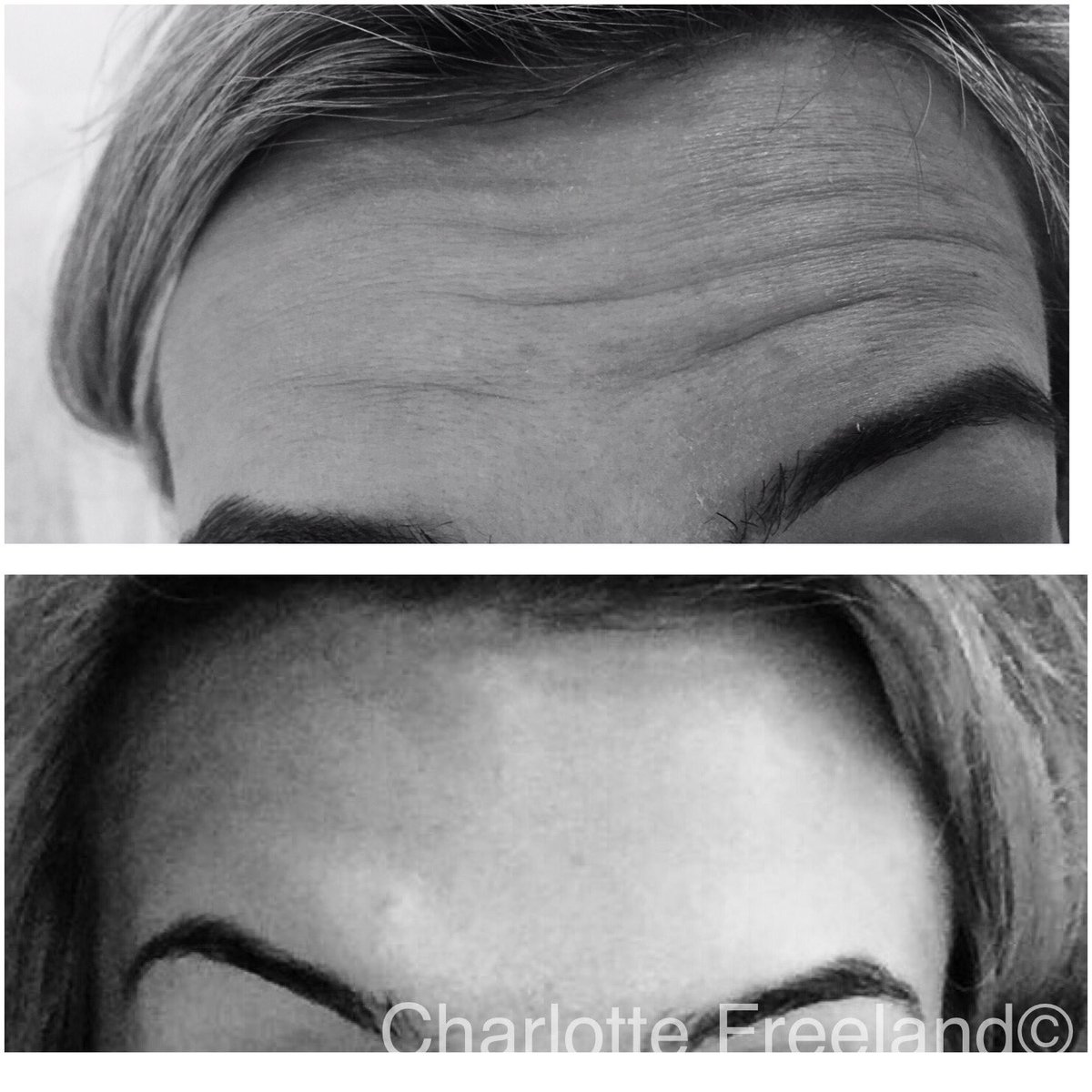 CF_Aesthetics_'s tweet photo. •B O T O X• #aesthetic #filler #botox #lipaugmentation #lipfillers #lipinjections #nonsurgical #cosmeticprocedures #juvederm #restylane https://t.co/KjZhulchAa