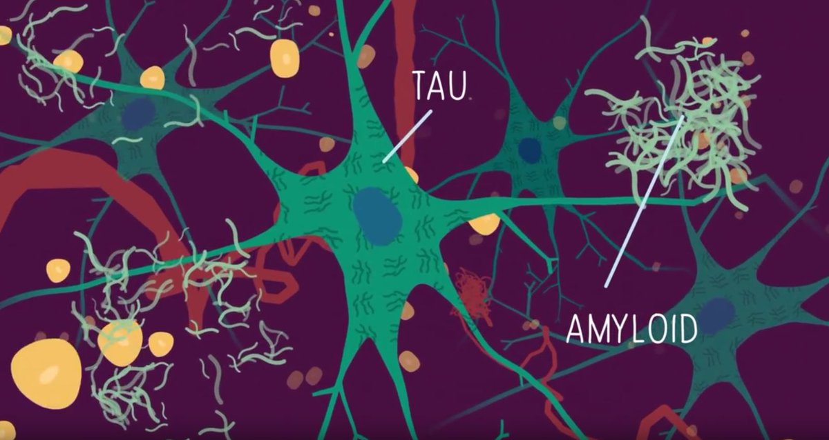 AlzResearchUK's tweet photo. Want to know more about dementia? Our new animation voiced by @iwanrheon explains the essentials. https://t.co/NSofvOijWG https://t.co/aTwTI2ujfk