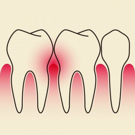 BeataCarlson's tweet photo. Do not gum disease affect your body! #dentalcare #gums #holisticdds #drbeatacarlsondds
https://t.co/32UpbSYrL6 https://t.co/kqzq2fIN8p