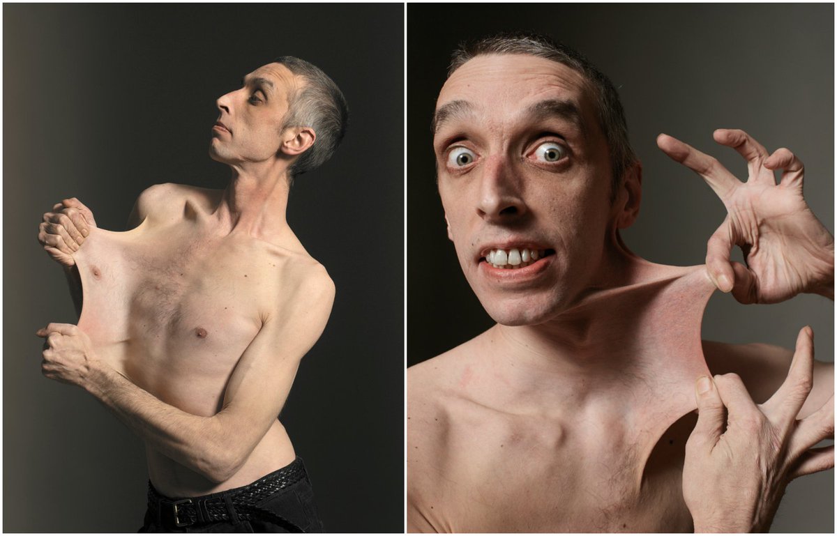 Guinness World Records on Twitter: "Our #FlashbackFriday goes to record holder Garry Turner, who was given the title world's stretchiest skin in 1999 > https://t.co/5pG8V2RJcR… https://t.co/ducUaJWR38"