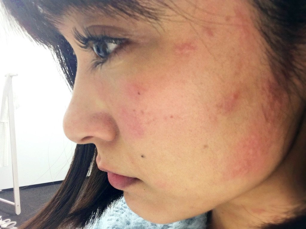 金子みひろ 顔がボコボコになっちゃうの 寒冷蕁麻疹って治らないのかなぁ 金子みひろ 顔がボコボコになっちゃうの 寒冷蕁麻疹って治らないのかなぁ