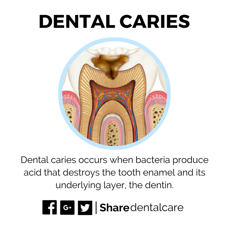 ShareDentalCare's tweet photo. Dental caries occurs when bacterial acid destroys the tooth enamel and its underlying layer.
#Dentistry #Dental_Caries #Tooth_Decay https://t.co/oOJpl7aplm