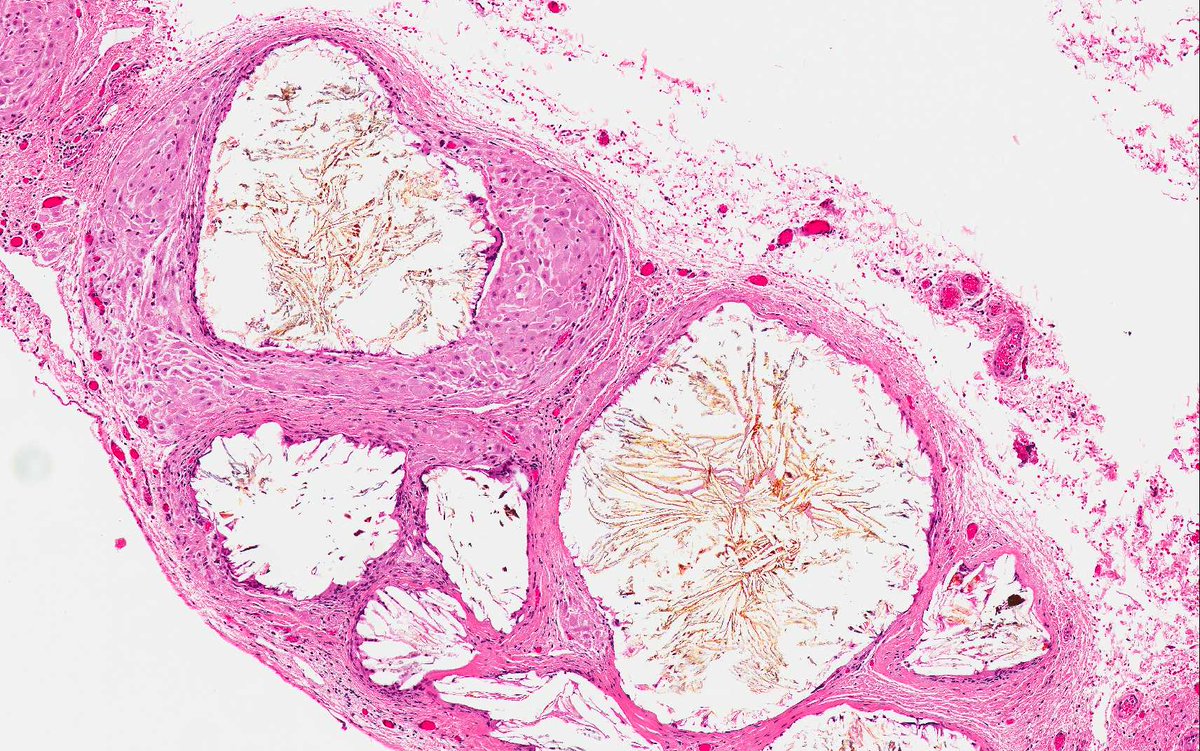 egoebs's tweet photo. Suspicious peritoneal nodules, not always malignant..Case of omental cholelithiasis at c-section. #frozensectionpitfalls #Gynpath #SurgPath https://t.co/l9MZ6KglAv