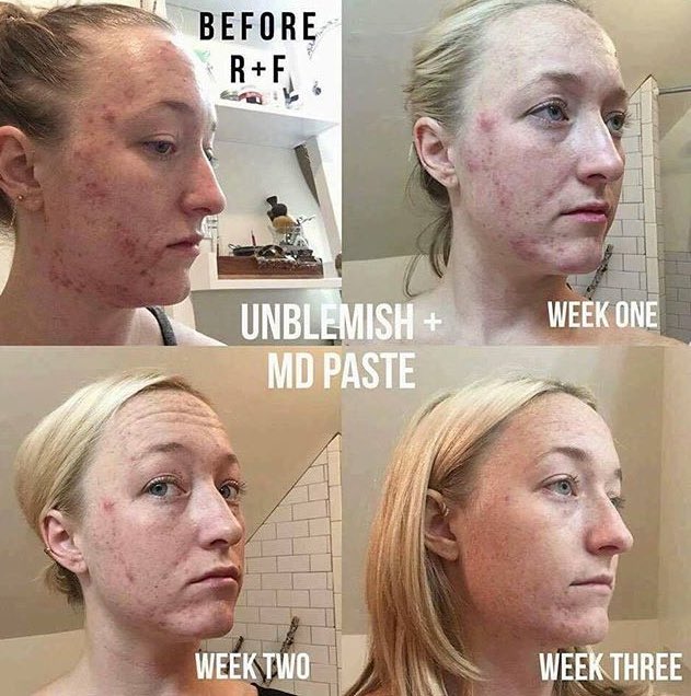 clear skin but R+F has given hope