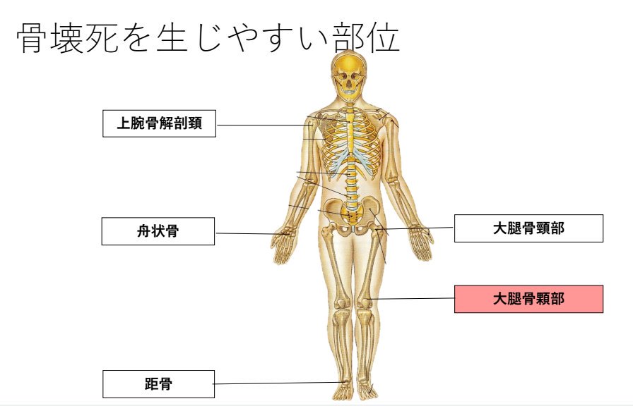 Pt Ot国試間違えやすいとこ على تويتر 骨壊死と偽関節 骨壊死と偽関節の好発部位はほぼ同じ 異なる部分をおさえとく 骨壊死は 大腿骨顆部 偽関節は脛骨に生じやすい