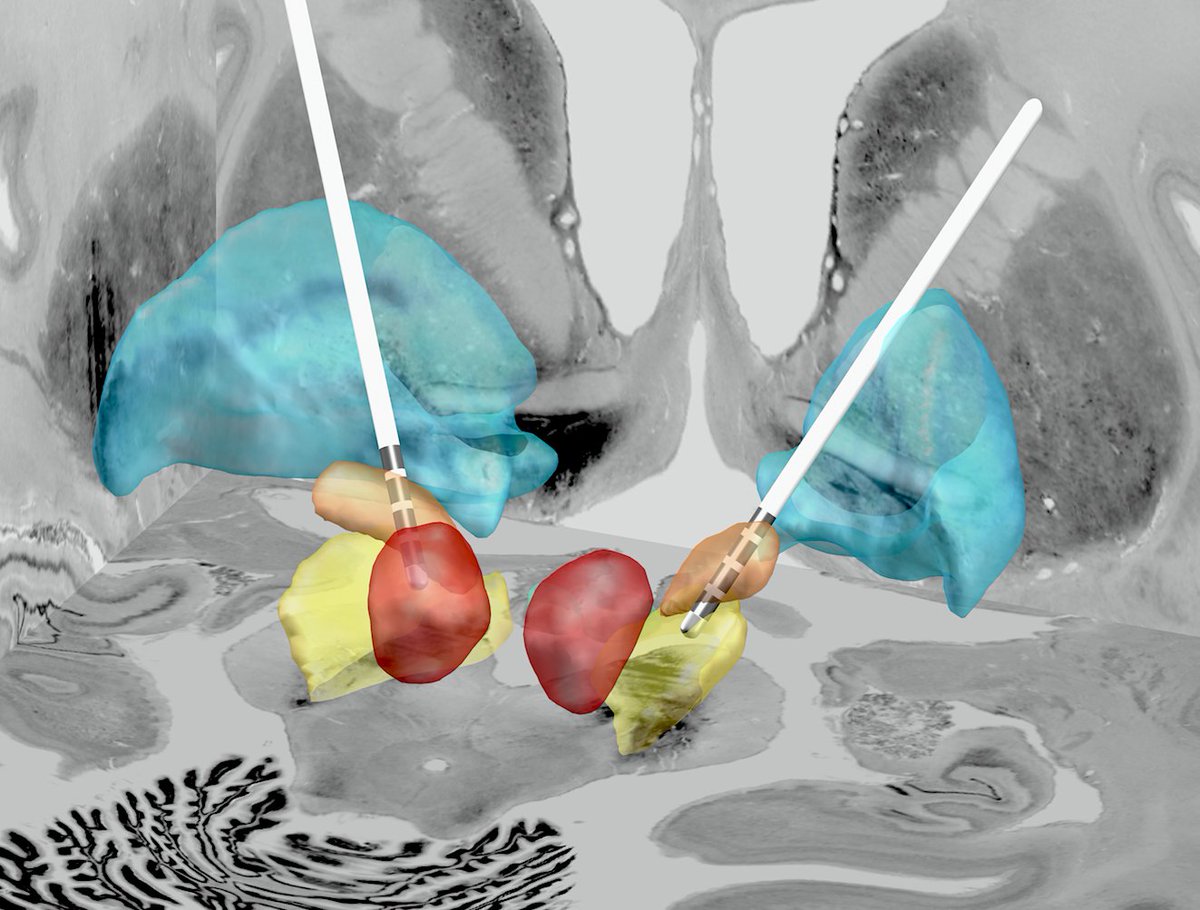 leaddbs's tweet photo. Adding the new ultra high-field DBS atlas by Wang et al. to Lead-DBS – great dataset avl. here https://t.co/q71HJ2Tbal https://t.co/3EUZAGrUb3