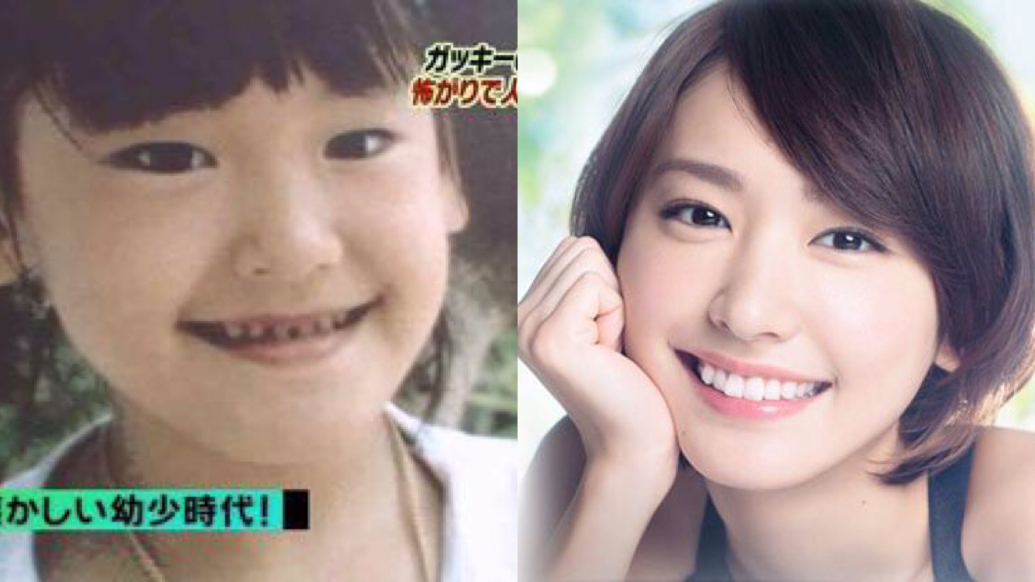 とぅるぴ Twitter પર 歯列矯正した芸能人達 けして矯正だけで綺麗になったわけではないけど 歯並びの与える印象は大きい 矯正は痛くて辛いし見た目も気になるし嫌な思いも沢山する でも コンプレックスがひとつ消せる 歯並び一つで変われる 心折れそうになっ とぅるぴ Twitter પર 歯列矯正した芸能人達 けして矯正だけで綺麗になったわけではないけど 歯並びの与える印象は大きい 矯正は痛くて辛いし見た目も気になるし嫌な思いも沢山する でも コンプレックスがひとつ消せる 歯並び一つで変われる 心折れそうになっ