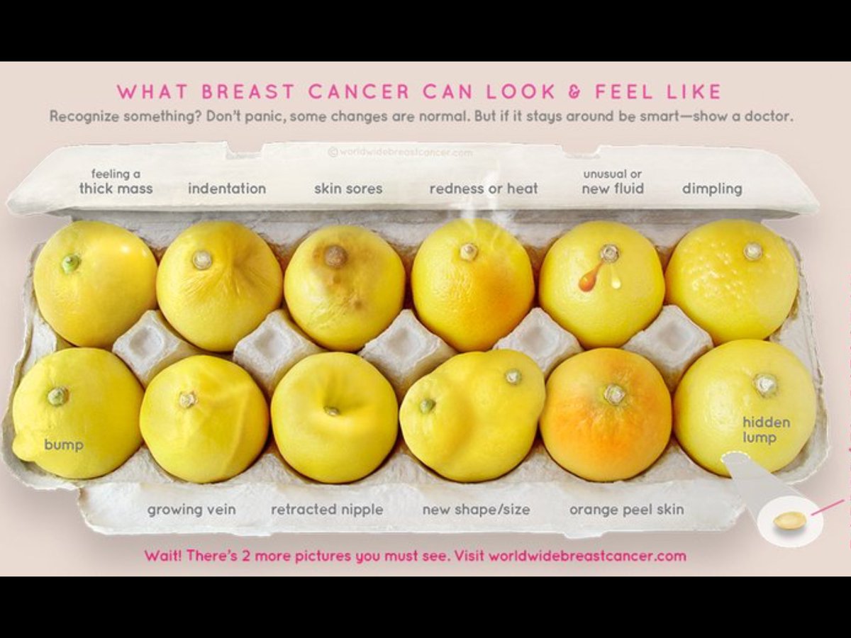 DavinaRivers's tweet photo. Inflammatory Breast Cancer.Perhaps my mum could have survived it had she checked her breasts regularly for lumps 😰 #Redness #Heat #ThickMass https://t.co/XihDBjgQMy