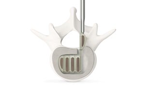 SpinalNewsInt's tweet photo. First implantation using Vertebral Technologies’ #Interfuse in Mexico a success @vtispine https://t.co/VTyzhLS7Pt https://t.co/YzJsEy14s2