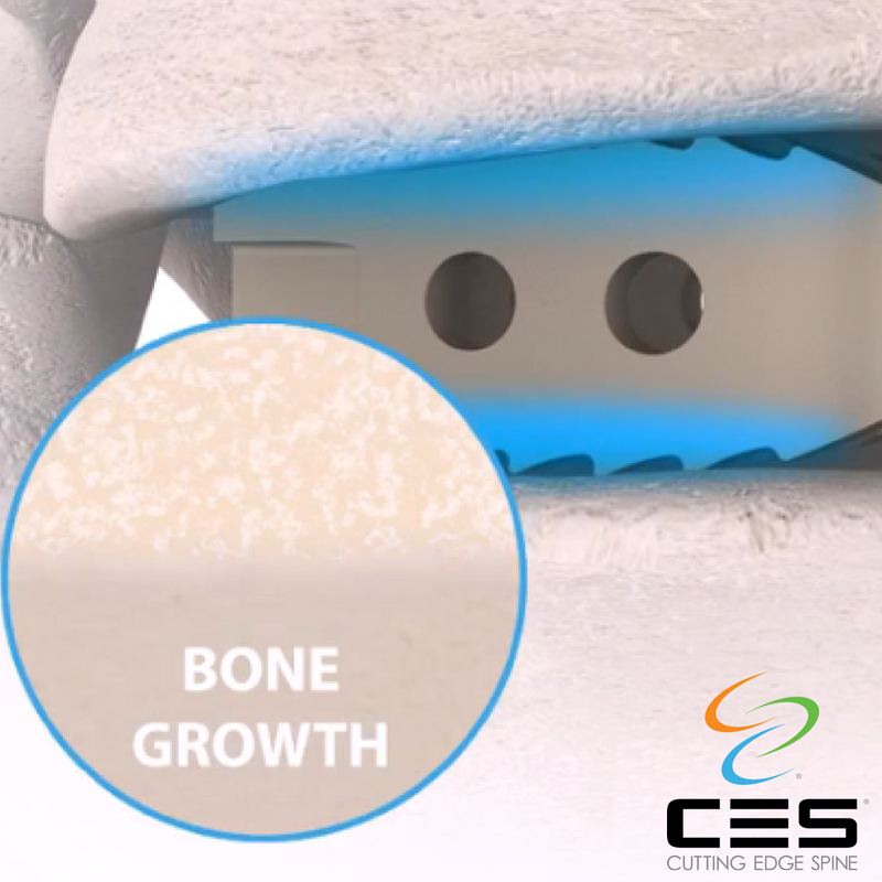 CESSpine's tweet photo. Visit our website to learn about the superior new bone formation of the #EVOS Ha! #medicaldevice #spinaltechnology https://t.co/BwGNfBcjIN https://t.co/FCzQOT3p6k