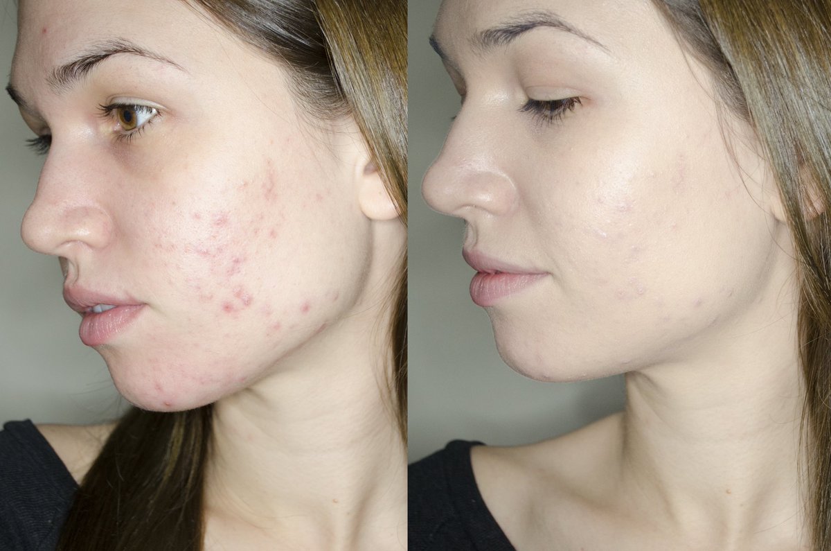 more_rebe's tweet photo. Review of the @CoverFX foundation that gave me these results will be #ontheblog tomorrow! #bbloggersca #foundation #acnecoverage https://t.co/PIKBUEjySK