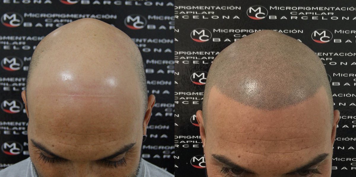 micropigcapibcn's tweet photo. Pide consulta totalmente gratuita 600 634 616 #MCBarcelona #micropigmentacion #capilar #barcelona #efectorapado #clinica #consulta https://t.co/hlhqn7xT0p