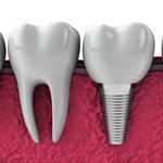 Photo by Rusthall Dental (@rusthalldental)