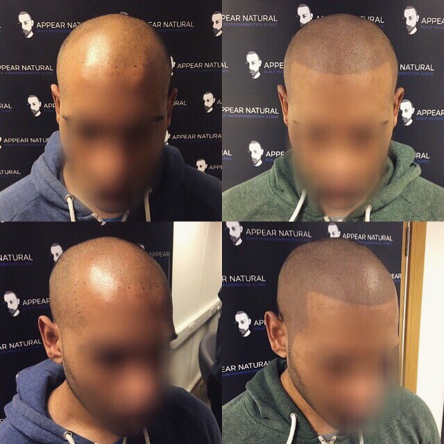 AppearN's tweet photo. Call 02037222338 to book a free consultation and say goodbye to hair loss! @BeckBromFL @bromleyfl @Bromley_UK_News @karmastudios https://t.co/w6aGK4UrnR