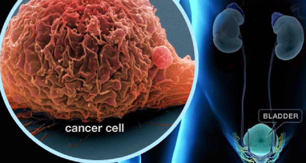 Anyone can get bladder cancer, but some factors put you at greater risk. Learn more: wb.md/2j4VLBH