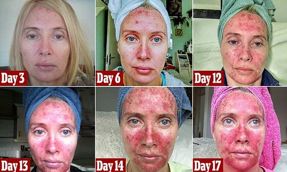 TrendMagnetHQ's tweet photo. Mother who loved sunbeds shares graphic selfies of treatment for precancerous cells on her face to warn addicts https://t.co/1jEMT1PfYe https://t.co/56bEwUQFRT